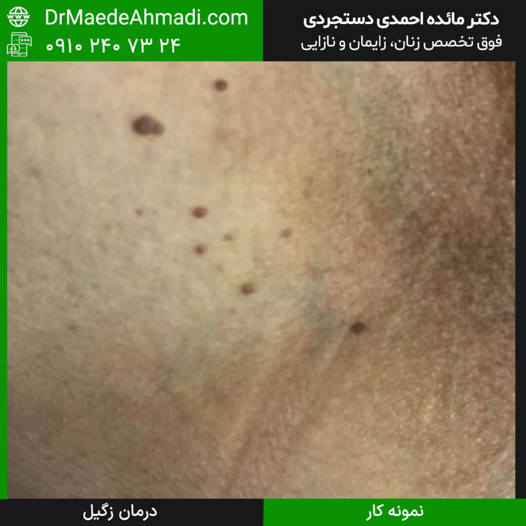 زگیل تناسلی زنان چطور درمان میشود؟