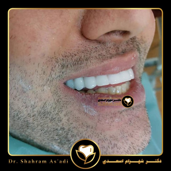 ایمپلنت دندان افراد دیابتی